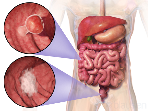 Colorectal_cancer