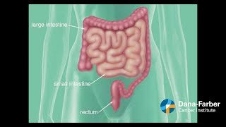 Colon v. Rectal Cancer: What you need to know