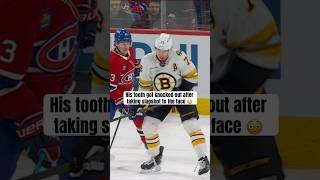 Charlie McAvoy’s tooth fell out 👀