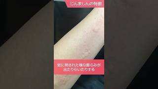 蕁麻疹の特徴 #千里中央花ふさ皮ふ科 #じんましん #shorts