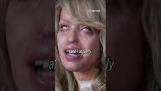 My Facebook Stalker Threw Acid In My Face | Katie Piper | pt.4 |