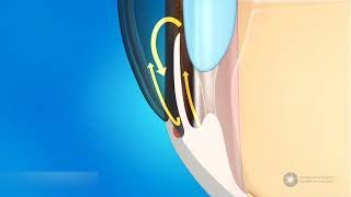 Glaucome à angle ouvert ou fermé - Hypertension oculaire abîmant le nerf optique