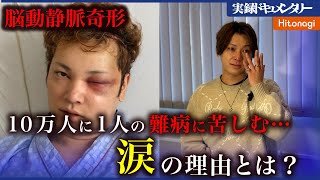 【涙】AVMと戦い続ける難病インフルエンサー間瀬さんが涙した理由とは…