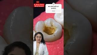 Root Canal Treatment| RCT| Dr. Shweta Sharma #teethdecay #doctor
